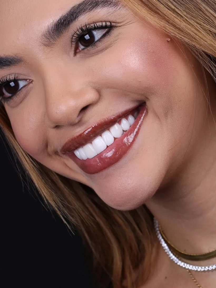 Paciente sorrindo com lentes de contato dental
